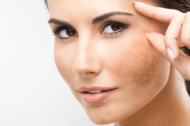 Como prevenir manchas na pele
